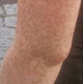 sommersprossen